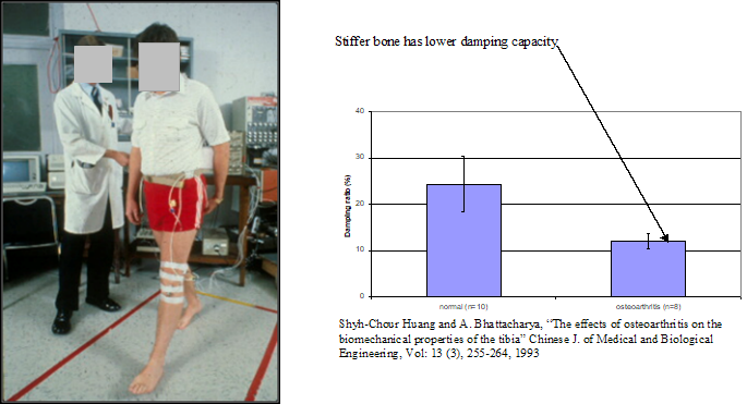 osteoarthritis-prescreening A person standing with osteoarthritis measuring equipment. Also a bar chart comparing a normal bone, and a bone with osteoarthritis. The graph shows the bone with osteoarthritis measures a lower damping capacity
