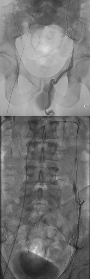 male-varicocele-embolization